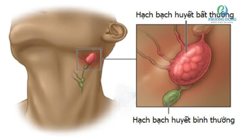 điều trị ung thư hạch bạch huyết