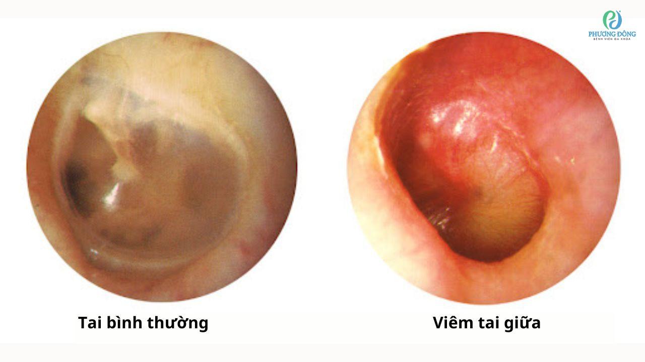 So sánh tai bình thường và viêm tai giữa