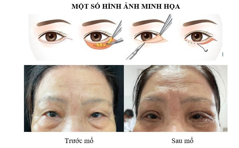 PHẪU THUẬT CẮT DA THỪA MI DƯỚI