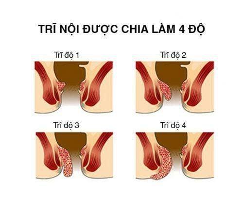 Trĩ nội độ 2 điều trị thế nào?