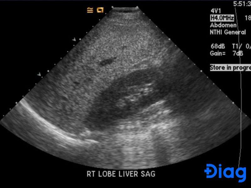 Hình ảnh gan nhiễm mỡ trên siêu âm là công cụ quan trọng để chẩn đoán bệnh.